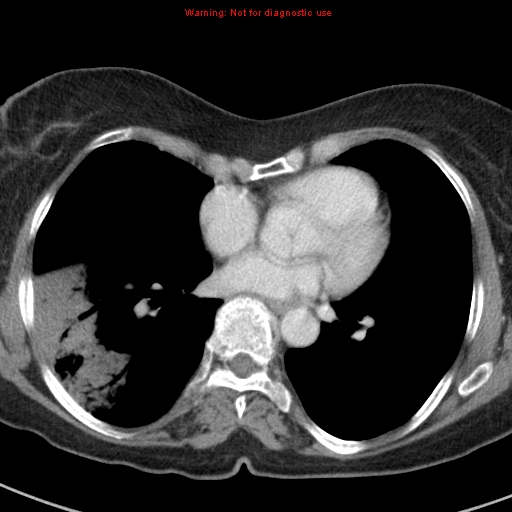 File:Bronchoalveolar carcinoma (BAC) (Radiopaedia 13436-13392 B 32).jpg
