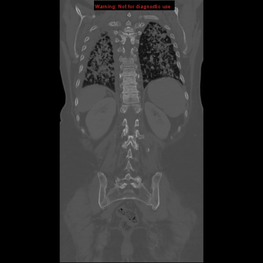 File:Bronchoalveolar carcinoma (Radiopaedia 13224-13233 Coronal non-contrast 23).jpg