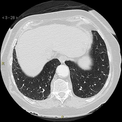Bronchogenic carcinoma as an incidental finding (Radiopaedia 16453-16130 Axial lung window 28).jpg
