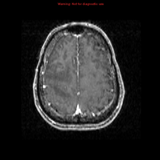 File:Bronchogenic carcinoma brain metastasis (Radiopaedia 9286-9969 Axial T1 C+ 20).jpg