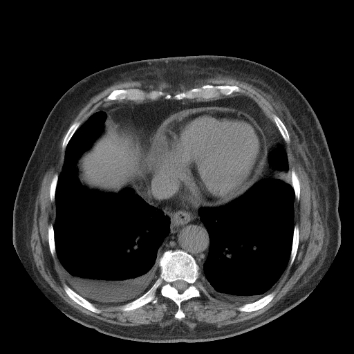 Bronchogenic carcinoma with metastatic lymphadenopathy (Radiopaedia 37671-39569 Axial non-contrast 41).jpg