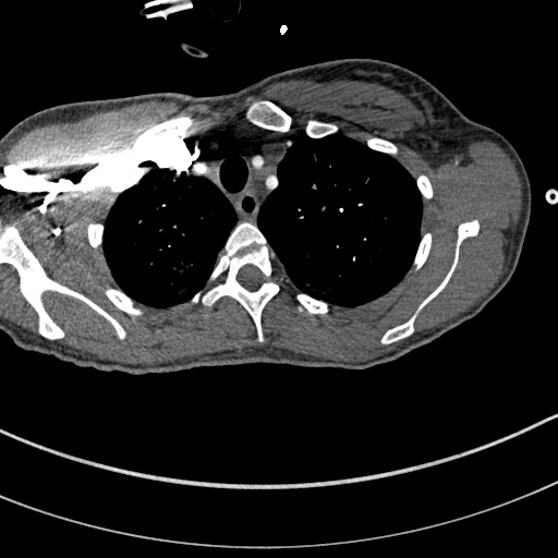 Bronchogenic cyst (Radiopaedia 77801-90071 Axial C+ CTPA 2).jpg
