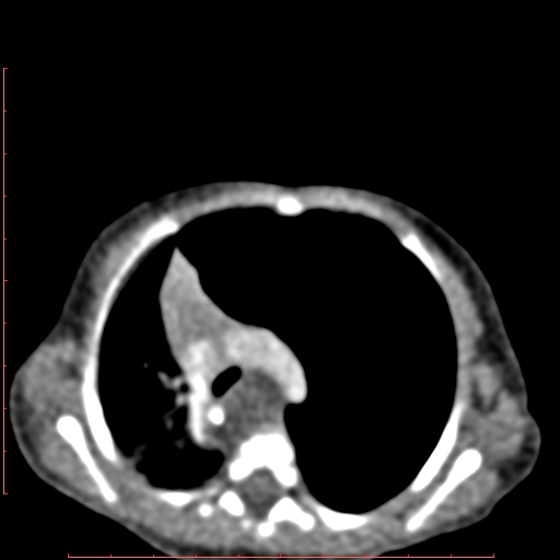 Bronchogenic cyst (Radiopaedia 78599-91409 B 80).jpg