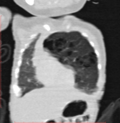 Bronchogenic cyst (Radiopaedia 78599-91409 Coronal lung window 55).jpg