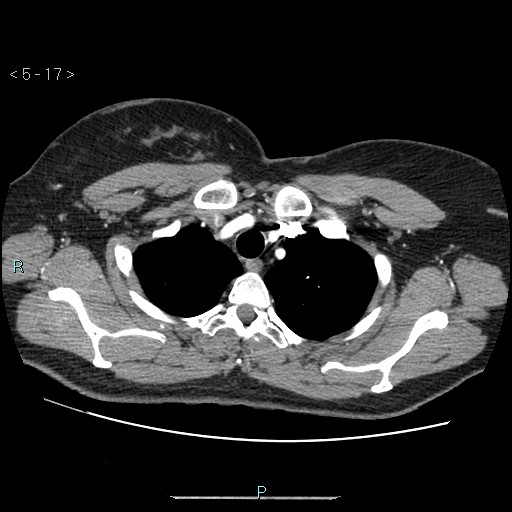 Bronchogenic cyst - posterior mediastinal (Radiopaedia 43885-47364 A 10).jpg