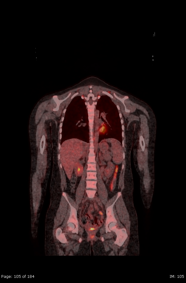Brown fat uptake (FDG PET-CT) (Radiopaedia 77392-89513 Fused coronal 63).jpg