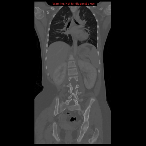 File:Brown tumor (Radiopaedia 12318-12596 D 41).jpg