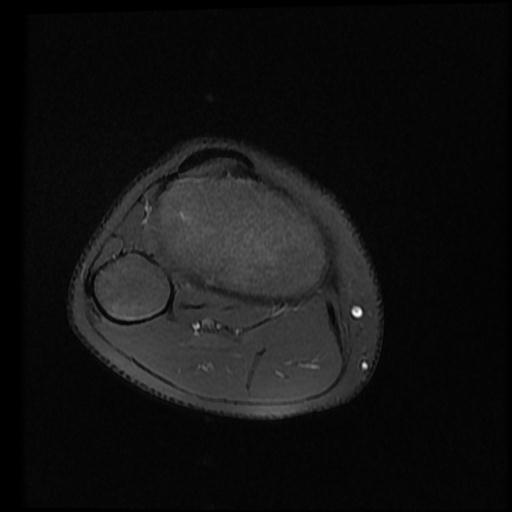 File:Bucket handle tear - lateral meniscus (Radiopaedia 72124-82634 Axial PD fat sat 15).jpg