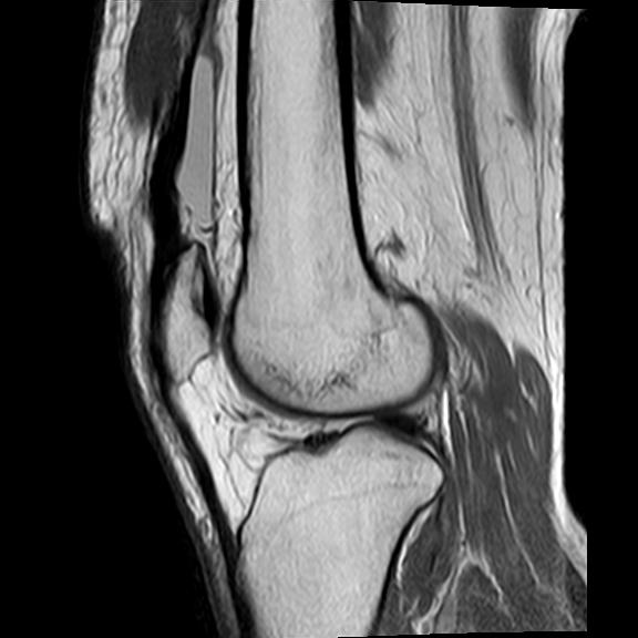File:Bucket handle tear - medial meniscus (Radiopaedia 29250-29664 Sagittal PD 8).jpg