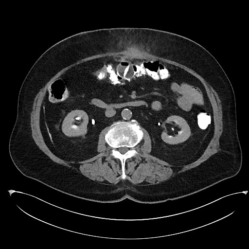 File:Buried bumper syndrome - gastrostomy tube (Radiopaedia 63843-72577 Axial Inject 49).jpg