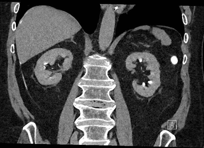 Buried bumper syndrome - gastrostomy tube (Radiopaedia 63843-72577 Coronal Inject 86).jpg