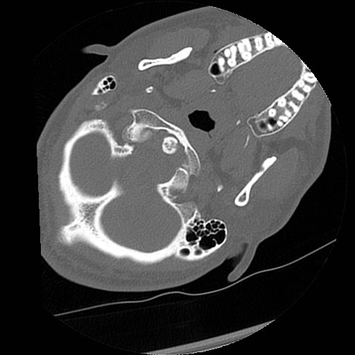 File:C1-C2 "subluxation" - normal cervical anatomy at maximum head rotation (Radiopaedia 42483-45607 Axial non-contrast 60).jpg