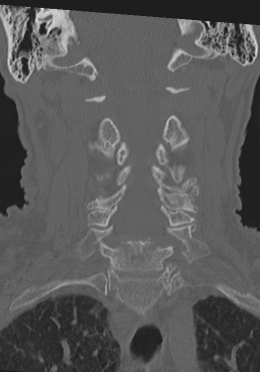 C2 fracture with vertebral artery dissection (Radiopaedia 37378-39199 Coronal bone window 25).png