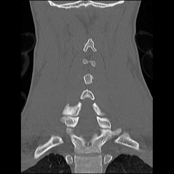 C5 facet fracture (Radiopaedia 58374-65499 Coronal bone window 40).jpg