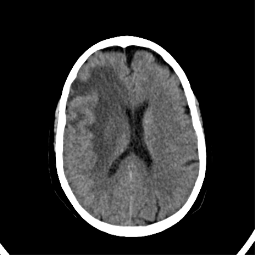 File:CNS Lymphoma (Radiopaedia 44198-47794 Axial non-contrast 23).png