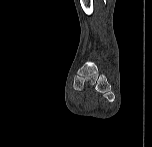 Calcaneal fracture - Sanders type 4 (Radiopaedia 90179-107370 Coronal bone window 51).jpg