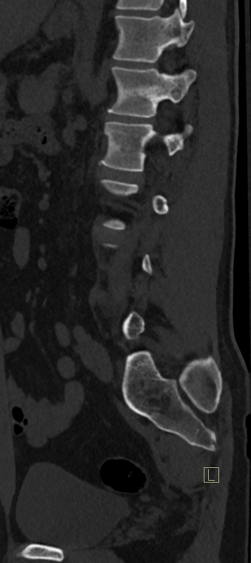 Calcaneal fractures with associated L2 burst fracture (Radiopaedia 71671-82493 Sagittal bone window 19).jpg