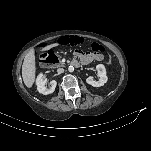 Calcified adrenal glands and Spigelian hernia (Radiopaedia 49741-54988 A 86).jpg