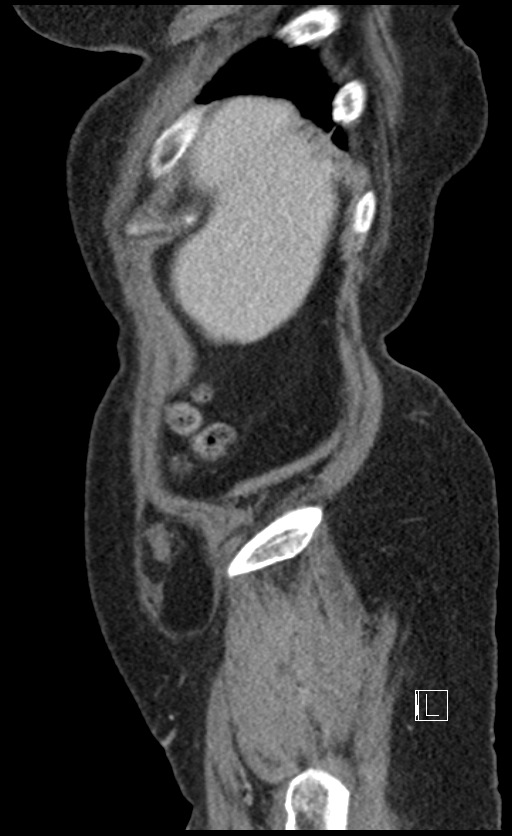 Calcified adrenal glands and Spigelian hernia (Radiopaedia 49741-54988 C 145).jpg