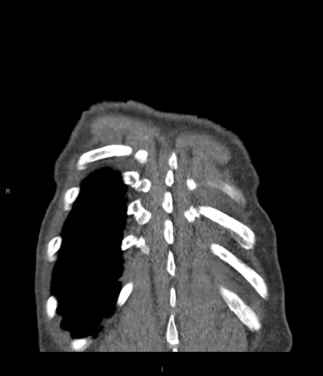 Calcified cerebral emboli from left ventricular thrombus (Radiopaedia 84420-99760 Coronal C+ CTPA 8).jpg