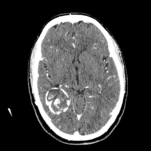 File:Calcified cerebral hydatid cyst (Radiopaedia 65603-74717 Axial with contrast 33).jpg