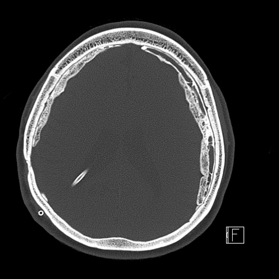 Calcified chronic subdural hematoma (Radiopaedia 77374-89492 Axial bone window 89).jpg