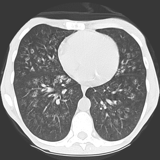 File:Calciphylaxis and metastatic pulmonary calcification (Radiopaedia 10887-11317 Axial lung window 29).jpg