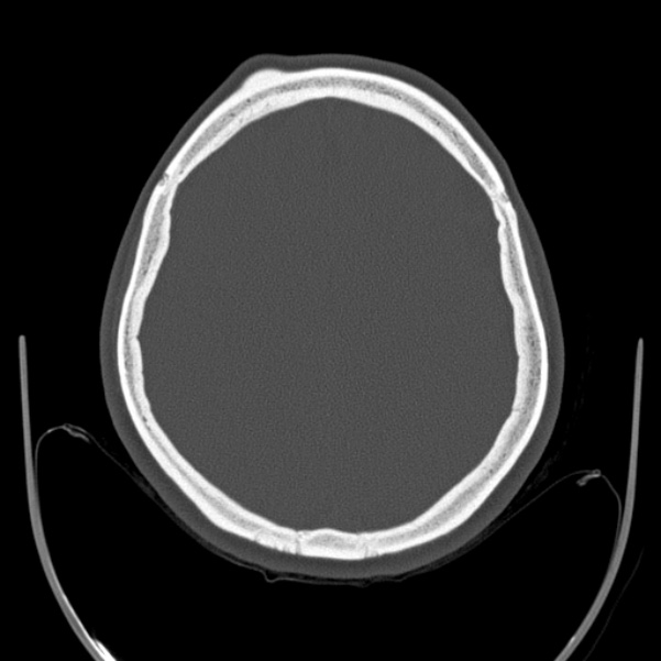 Calvarial osteoma (Radiopaedia 36520-38079 Axial bone window 75).jpg