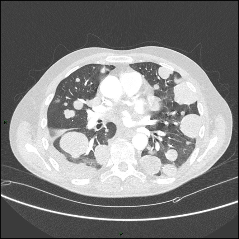 Cannonball metastases (Radiopaedia 82110-96150 Axial lung window 104).jpg