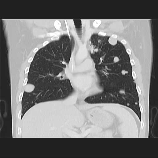 File:Cannonball pulmonary metastases (Radiopaedia 67684-77101 C 11).jpg