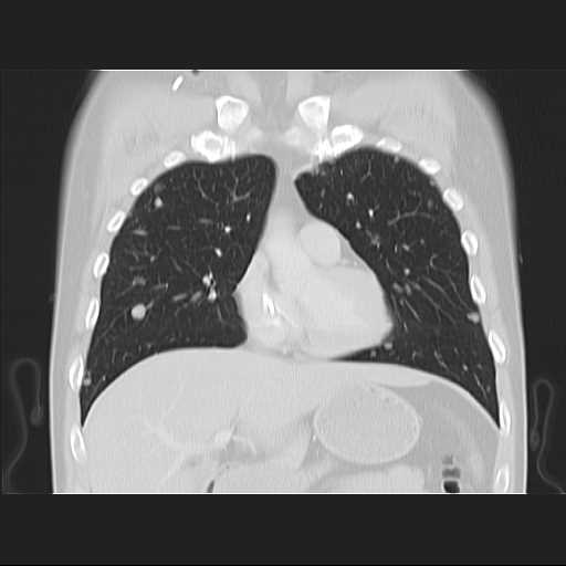 File:Cannonball pulmonary metastases (Radiopaedia 67684-77101 C 8).jpg