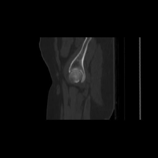 File:Carcinoma cervix- brachytherapy applicator (Radiopaedia 33135-34173 Sagittal bone window 6).jpg