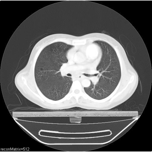 File:Carcinoma of esophagus (Radiopaedia 27356-27550 Axial lung window 19).jpg