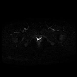 Carcinoma of the cervix (Radiopaedia 89018-105858 Axial DWI 6).jpg