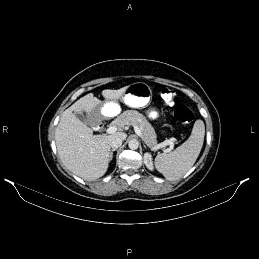 Carcinoma of uterine cervix (Radiopaedia 85861-101700 A 37).jpg