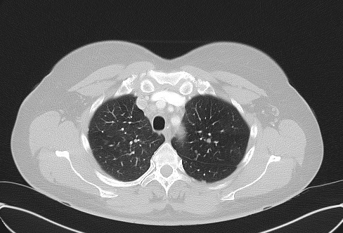 Cardiac sarcoidosis (Radiopaedia 74548-85534 Axial lung window 18).jpg