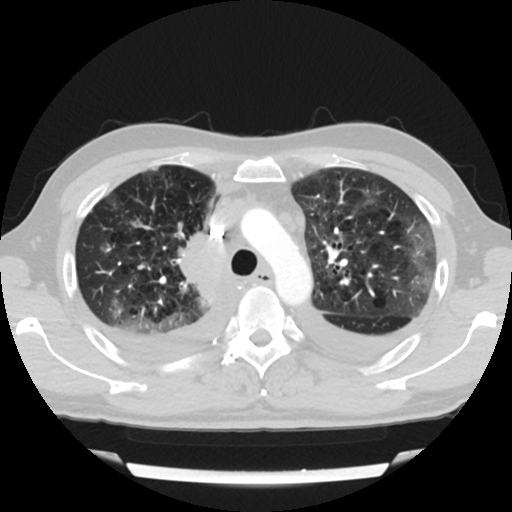 File:Cardiac tamponade (Radiopaedia 78607-91368 Axial lung window 20).jpg