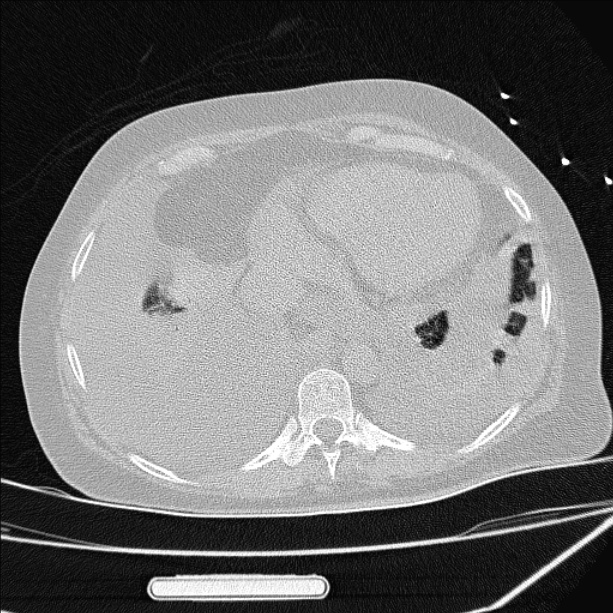 Cardiogenic pulmonary edema (Radiopaedia 29213-29609 Axial lung window 79).jpg