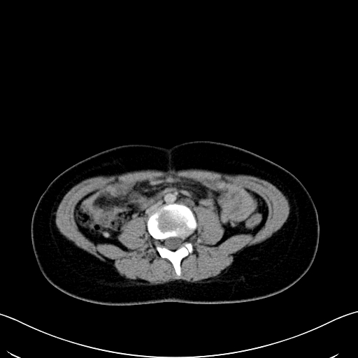 Caroli disease with medullary sponge kidney (Radiopaedia 82622-96804 C 42).jpg