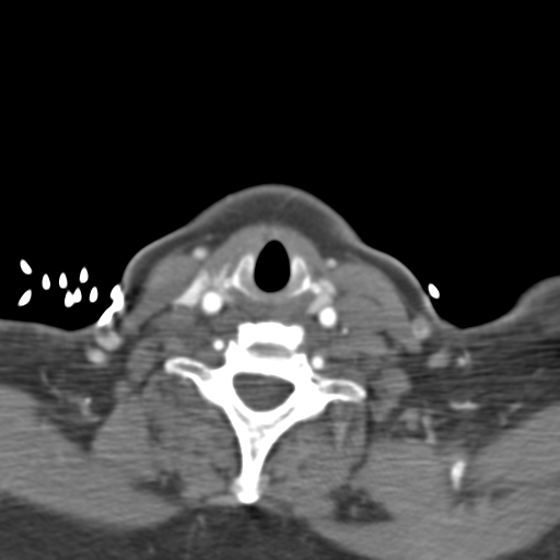 File:Carotico ophthalmic aneurysm (Radiopaedia 42916-46148 A 80).png