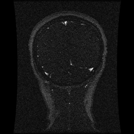 Carotid arterial dissection with acute cerebral infarction (Radiopaedia 26636-26784 MRV 53).jpg