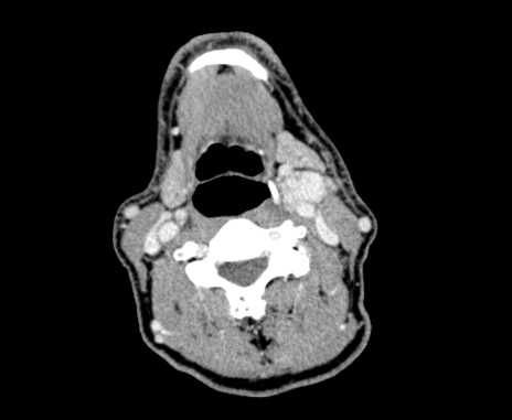 Carotid body tumor (Radiopaedia 61750-69757 Axial Post contrast 53).jpg