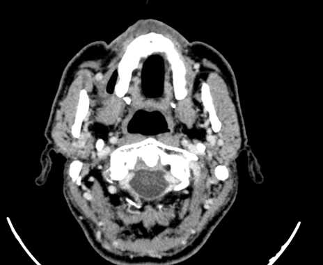 File:Carotid body tumor (Radiopaedia 61750-69757 Axial Post contrast 8).jpg