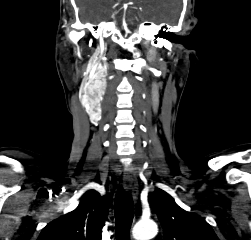 File:Carotid body tumor (Radiopaedia 83615-98727 B 73).jpg