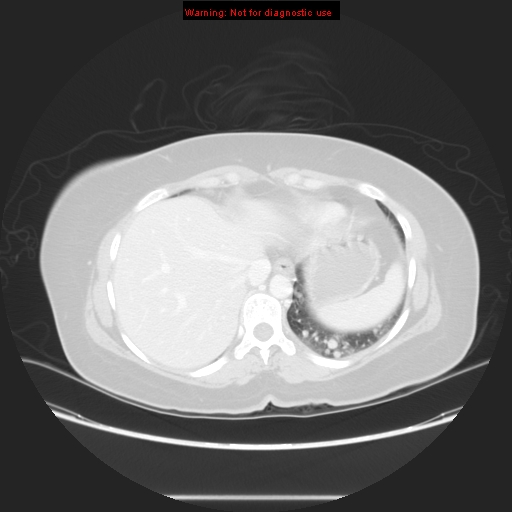 Carotid body tumor with lung metastases (Radiopaedia 9301-48390 Axial lung window 57).jpg