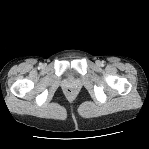 File:Castleman disease with fibrous pseudotumor in the abdomen (Radiopaedia 77296-89373 A 130).jpg