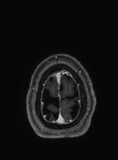 Cavernous hemangioma of the cerebellar falx (Radiopaedia 73025-83724 Axial T1 C+ 32).jpg