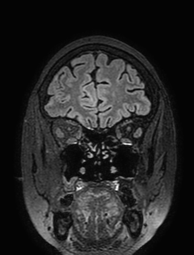 Cavernous hemangioma of the cerebellar falx (Radiopaedia 73025-83724 Coronal FLAIR 66).jpg