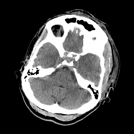 File:Cavernous sinus thrombosis (Radiopaedia 10619-11078 Axial non-contrast 12).jpg