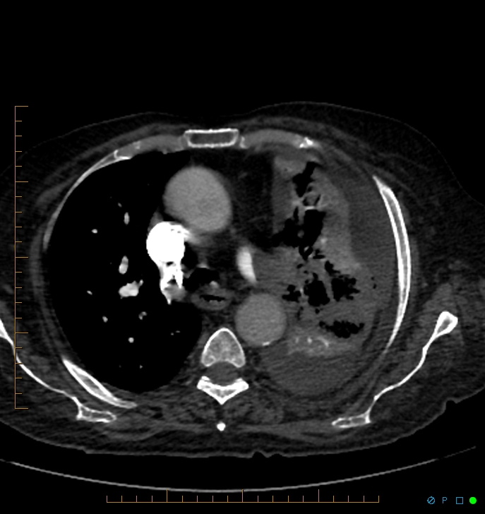 Cavitating pulmonary infarction (Radiopaedia 54634-60849 Axial C+ CTPA 23).jpg